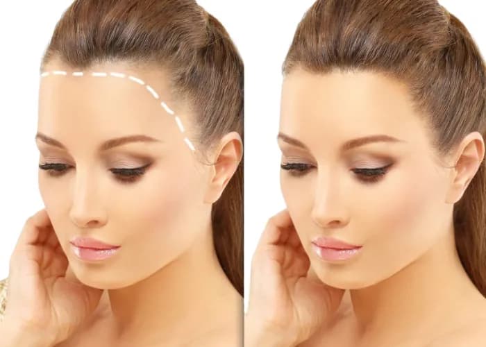 Hair Transplant Turkey Cost: How Many Grafts Do You Need?