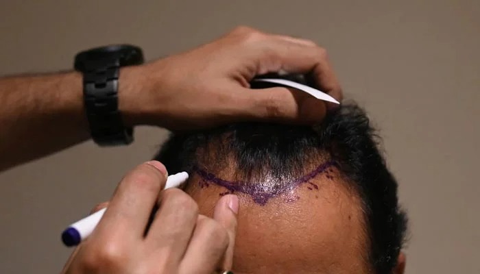 Hair Transplant Istanbul: Your Roadmap to Natural Hair Regrowth