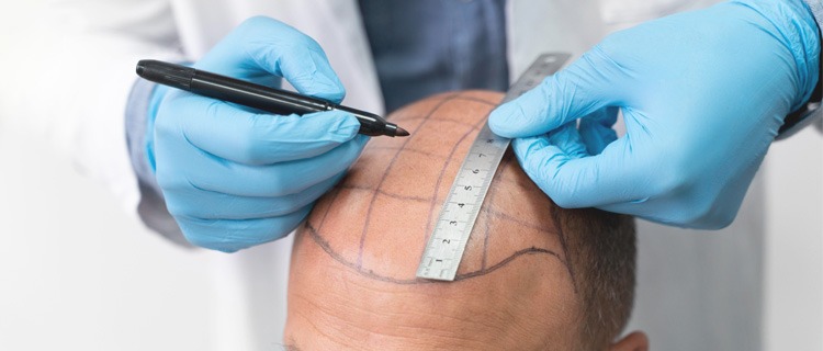 Sapphire Hair Clinic – Trusted Hair Transplant Turkey Clinic