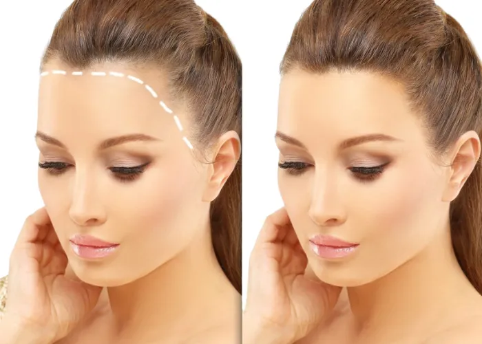 Hair Transplant Turkey Cost: How Many Grafts Do You Need?